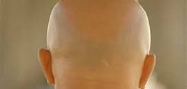 دراسة.. زراعة الشعر قد تزيد جاذبيتك لدى الآخرين 10 اصلع