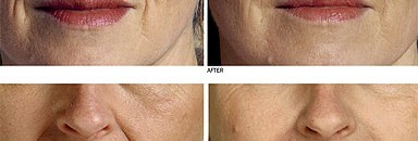 تجاعيد البشرة..قدر لابد منه لكن يمكن تأخيره 10 22107.png