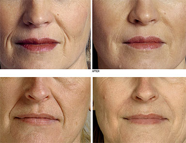 تجاعيد البشرة..قدر لابد منه لكن يمكن تأخيره 1 22107.png