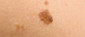 شامات الجلد