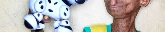 طفل هندي ينمو جسده بشكل مضاعف