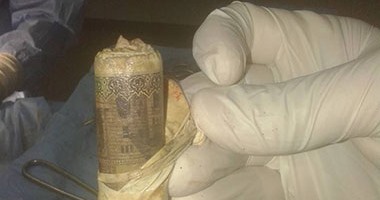 طبيب مصري يكشف تفاصيل استخراج ألف جنيه من بطن مريض.. ويؤكد: حرزنا المبلغ 1 مريض جنيه