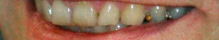 اسنان صفراء