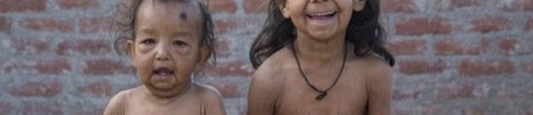 بالصور.. كيف يتحول الأطفال إلى مسنين في الهند؟ ما هو "Benjamin Button" ؟ 17 child to old