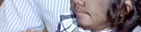 مخاوف والدي «الطفلة الذئب» تزداد بعد توقف علاجها2