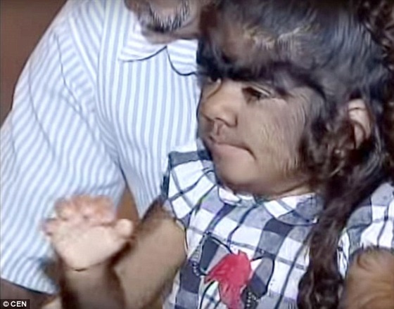 شاهد بالصور.. مخاوف والدي «الطفلة الذئب» تزداد بعد توقف علاجها 3 مخاوف والدي «الطفلة الذئب» تزداد بعد توقف علاجها2