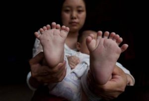 طفل صيني ولد بـ 31 إصبعاً!