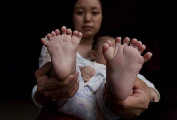 طفل صيني ولد بـ 31 إصبعاً