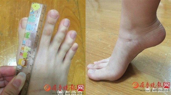 فتاة تثير ضجة على الإنترنت بسبب أصابع قدميها الطويلة