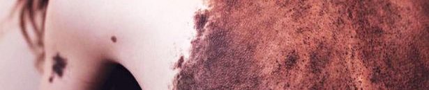 فتاة جميلة تمتلك جسما مغطى بالوحمات تتغلب على سخرية الناس