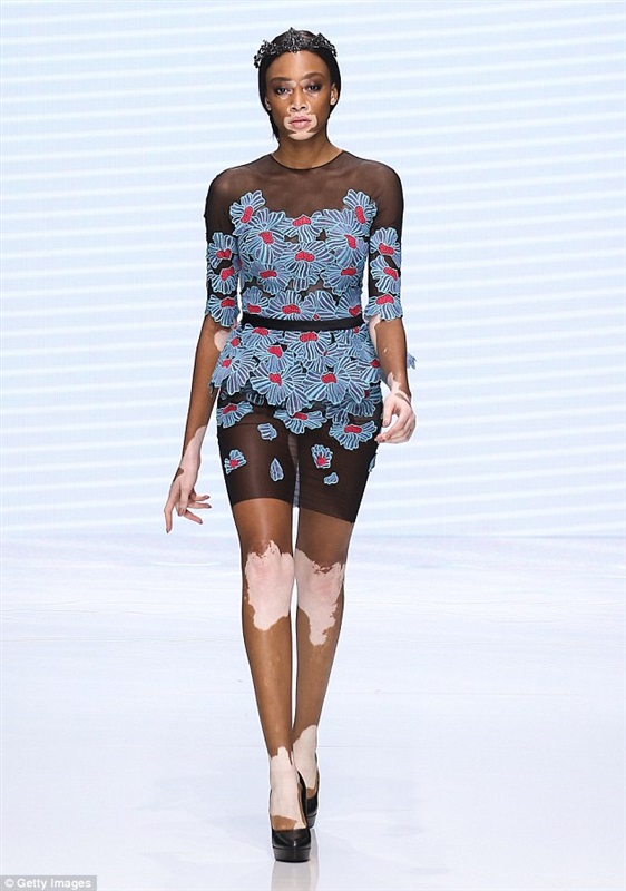 شاهد بالصور.. عارضة أزياء مريضة تخطف الأنظار في أسبوع الموضة بباريس 2 عارضة أزياء مريضة تخطف الأنظار في أسبوع الموضة بباريس