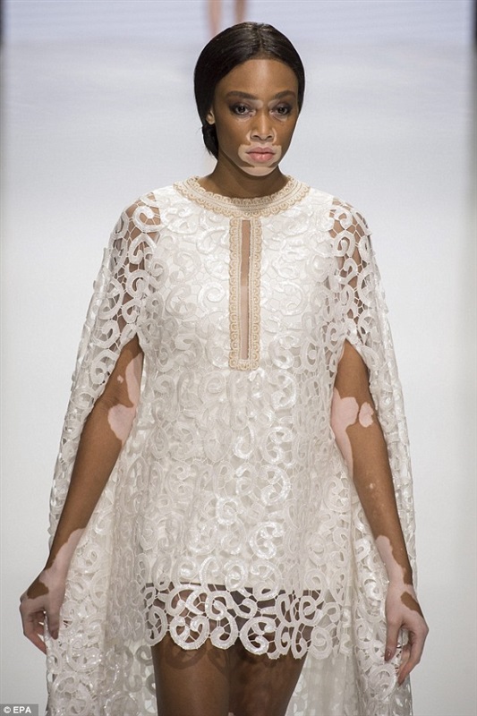 شاهد بالصور.. عارضة أزياء مريضة تخطف الأنظار في أسبوع الموضة بباريس 3 عارضة أزياء مريضة تخطف الأنظار في أسبوع الموضة بباريس1