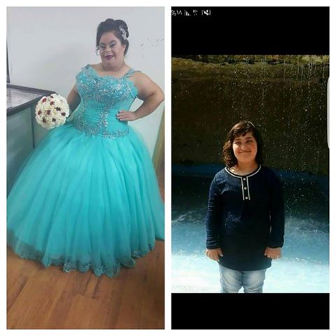 مريضة بمتلازمة داون