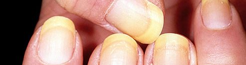 أبرز أسباب الإصابة بعدوى الأظافر الفطرية 10 ظافر يدين ظفر