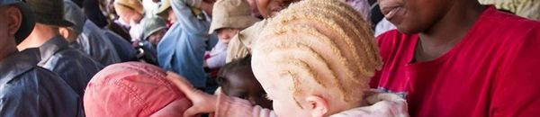 كل ما تريد معرفته عن مرض العصر الذي يصيب الملايين 10 مهق