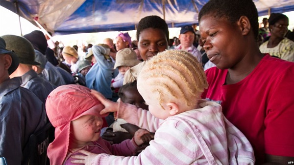 كل ما تريد معرفته عن مرض العصر الذي يصيب الملايين 1 مهق