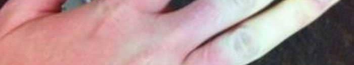 حمو النيل، الأسباب والأعراض وطرق العلاج 10 مض جلدي