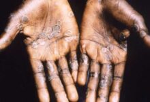 جدري القرود