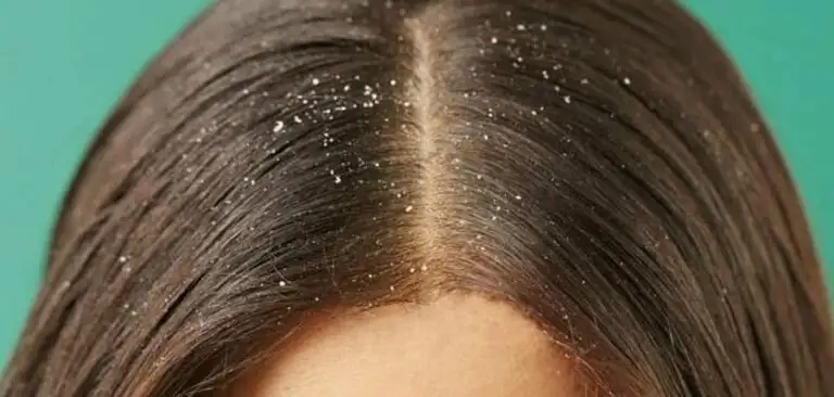 نصائح للعناية بفروة الرأس في المنزل 10 قشرة