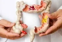 حالة مرضية بالقولون قد تسبب التهاب المفاصل.. ما هى؟ 38 201911180255415541