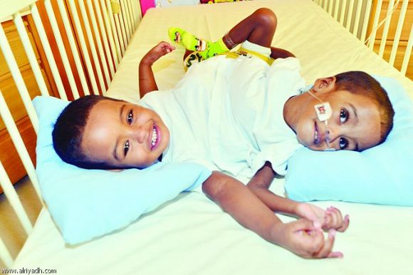 نجاح فصل توأم سيامي سوداني بشكل كامل بالسعودية 1 4512